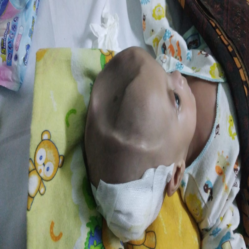Terserang Hidrosefalus, adik Aisyah Harus Segera Operasi