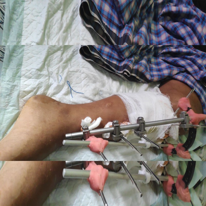 Bantu Iqbal Yatim Piatu sembuh dari Patah Tulang & Lumpuh supaya bisa sekolah kembali.