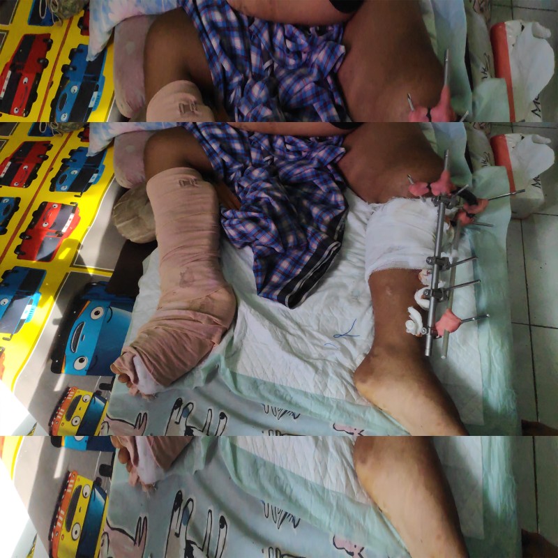 Bantu Iqbal Yatim Piatu sembuh dari Patah Tulang & Lumpuh supaya bisa sekolah kembali.