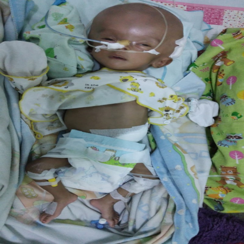 URGENT! Kepala Semakin Membesar, Asykila Harus Segera  Di Operasi!
