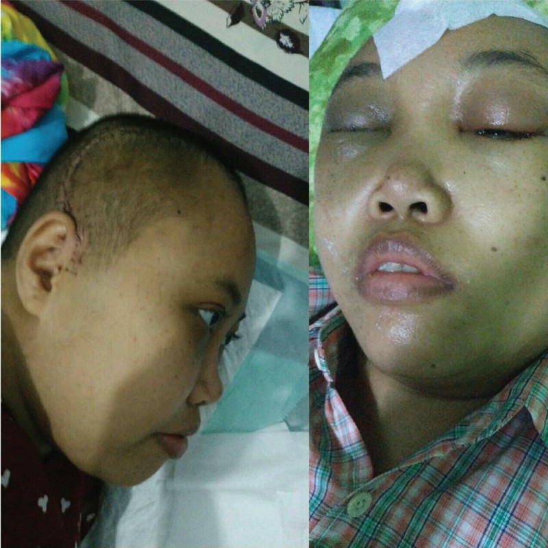 Lumpuh dan Pandangannya Gelap, Berikan Harapan Sembuh Untuk Bu Yunita dari Tumor Otak