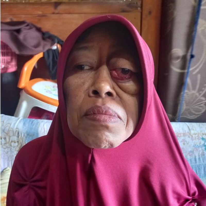 8 Tahun Menderita Pentyakit Mata Yang Mengancam Nyawanya, Bantu Ibu Momoh Sembuh