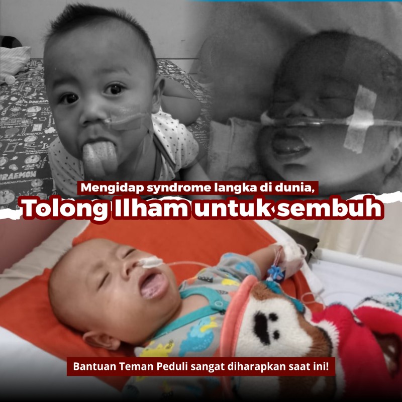 Mengidap syndrome langka di dunia, Tolong ilham untuk sembuh