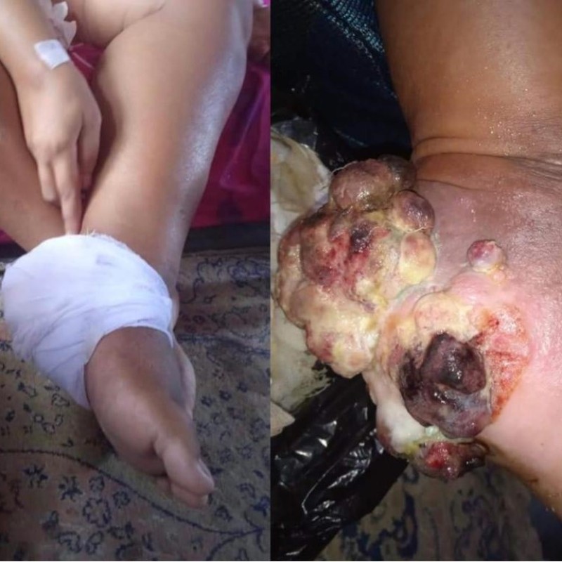 Mari Bantu Siti Lawan Tumor Ganas