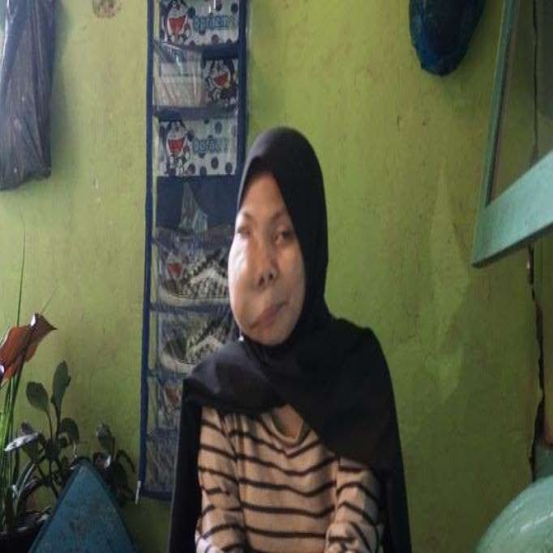 Tumor, sembuhlah.. Mutiara ingin wajahnya kembali normal