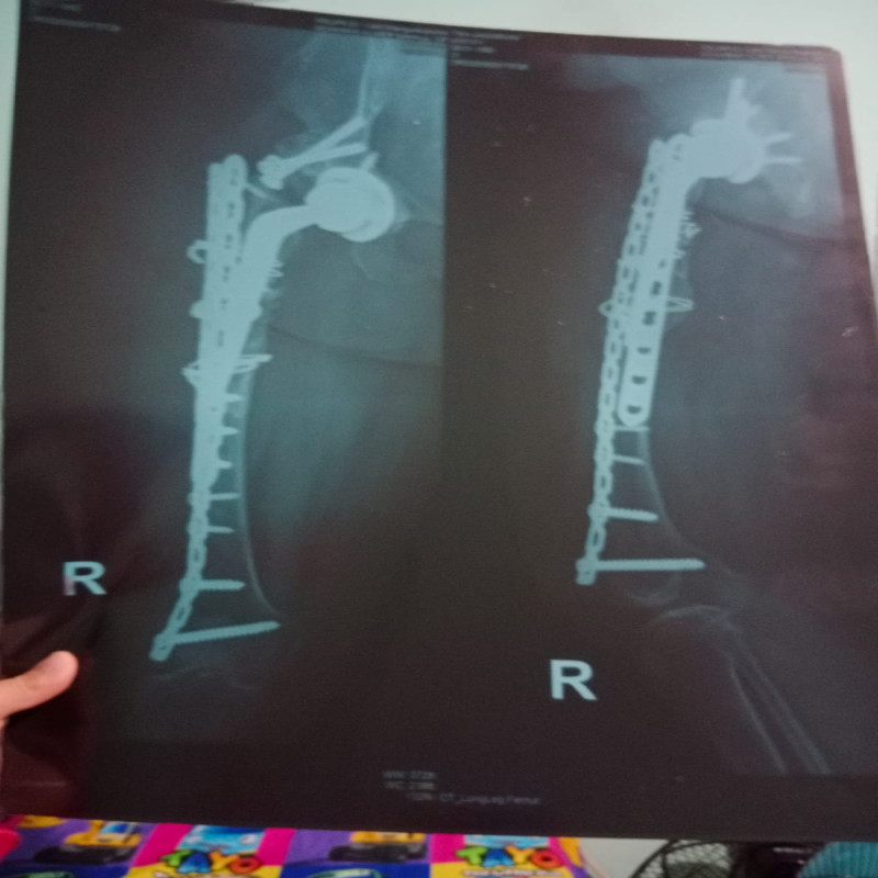 Bantu Tika melawan tulang rapuh dan THR femur