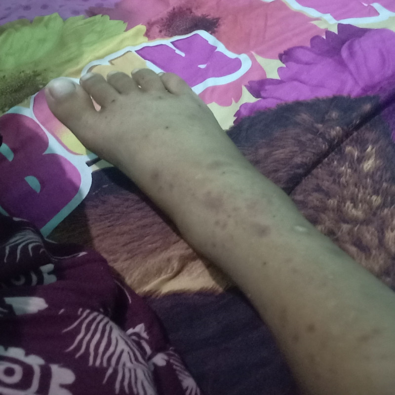 Bantu Yaya untuk sembuh, Yaya ingin sekali masuk SD tahun ini