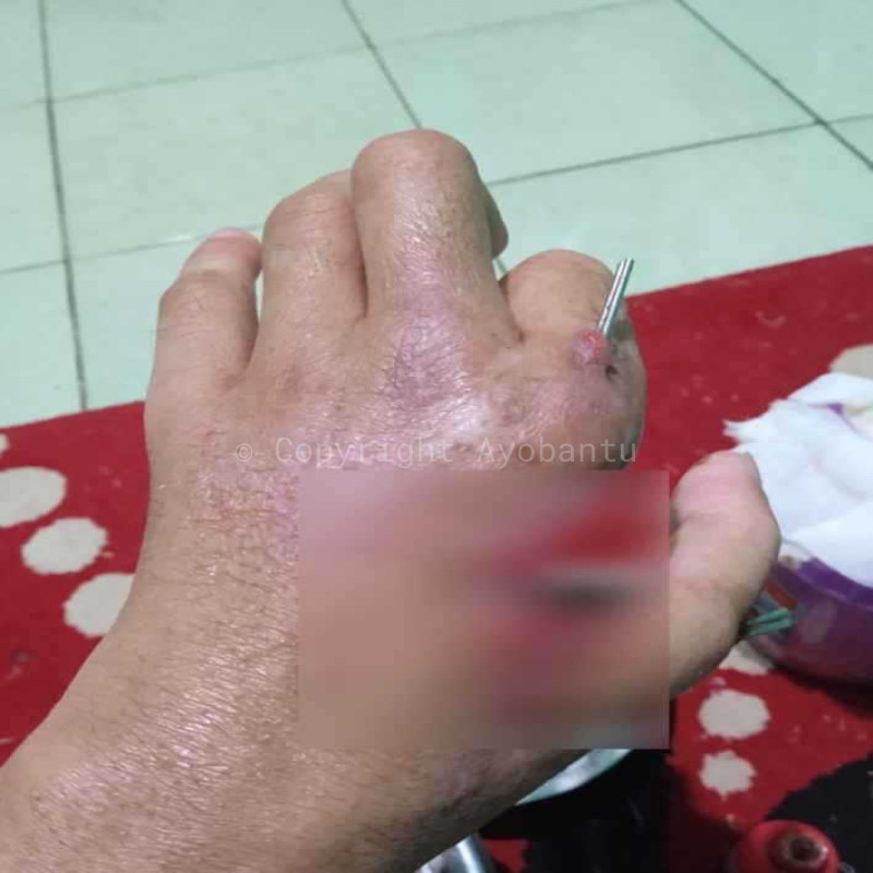 Tangan Hancur Akibat Ledakan, Operasi Tertunda Karena Tunggakan RS