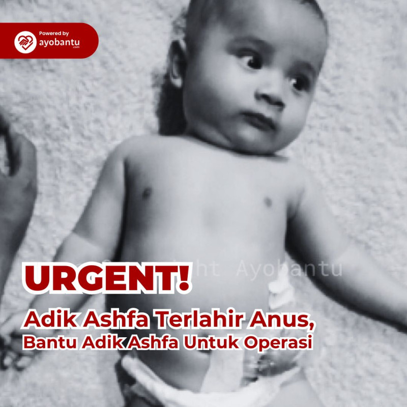 Bantu Bayi Ashfa Lahir Tanpa Anus, harus segera jalani 3 kali Operasi