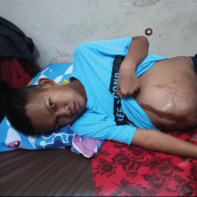 Perut Membesar dan Hampir Meletus, Bantu Jalaludin Operasi Tumor Ganas Segera!