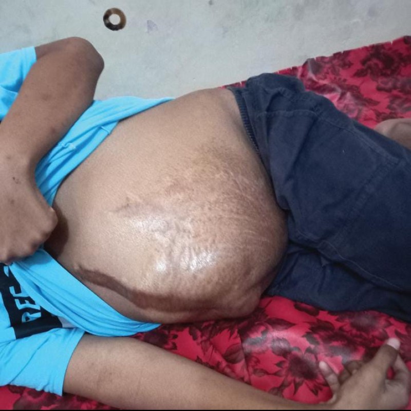Perut Membesar dan Hampir Meletus, Bantu Jalaludin Operasi Tumor Ganas Segera!