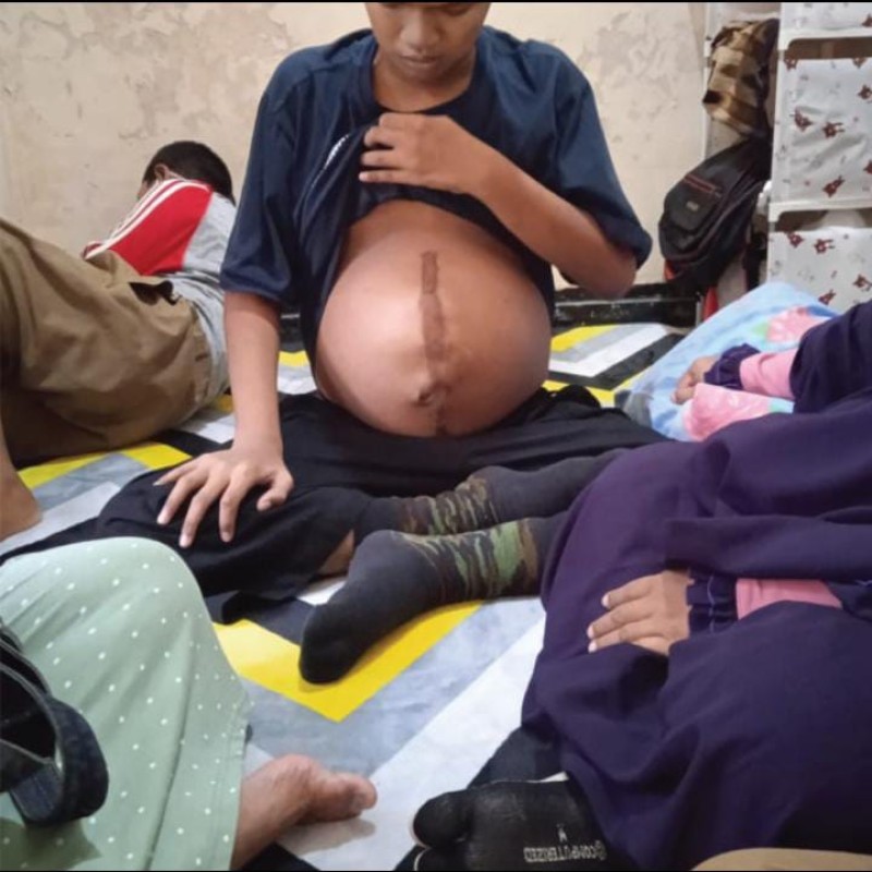 Perut Membesar dan Hampir Meletus, Bantu Jalaludin Operasi Tumor Ganas Segera!