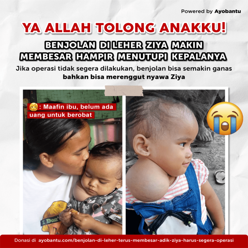 Benjolan di leher terus Membesar, Adik Ziya harus segera Operasi