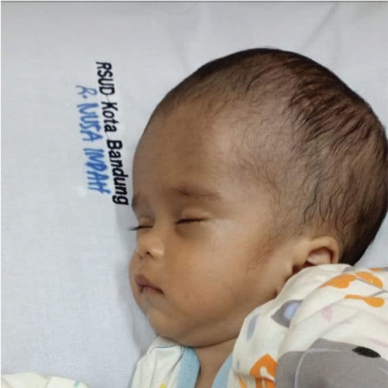Bertahun-tahun Dek Rasya Berjuang Dengan Penyakit Hydrocephalus. Mari Kita Bantu!