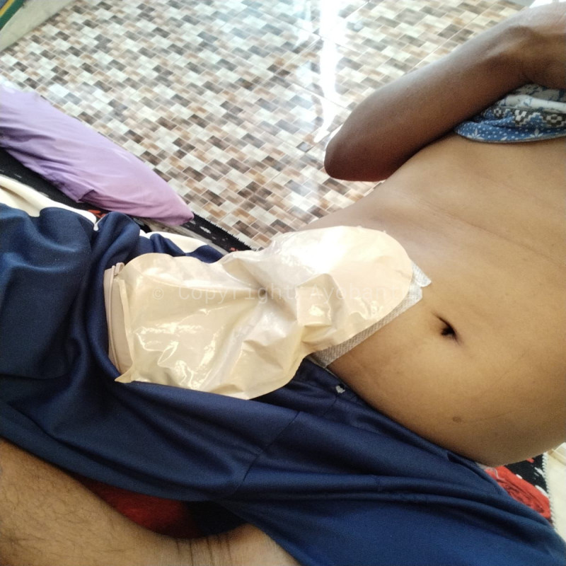 Tak Ada Biaya Berobat, Pak Ari Hanya Bisa Pasrah Dengan Keadaan!!