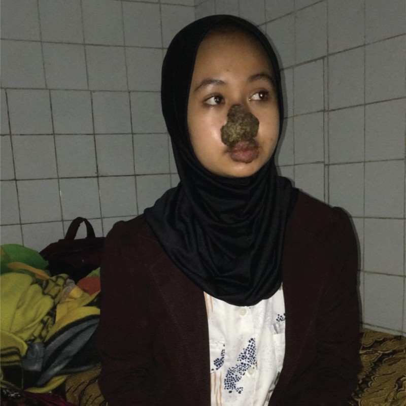 Urgent! Vira Harus Segera Operasi Penyakit Kulit yang Dideritanya