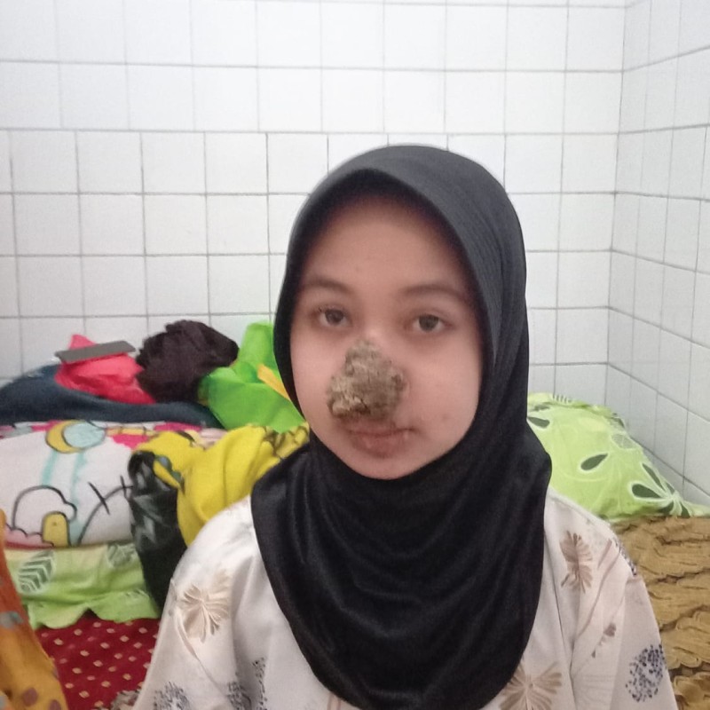 Urgent! Vira Harus Segera Operasi Penyakit Kulit yang Dideritanya