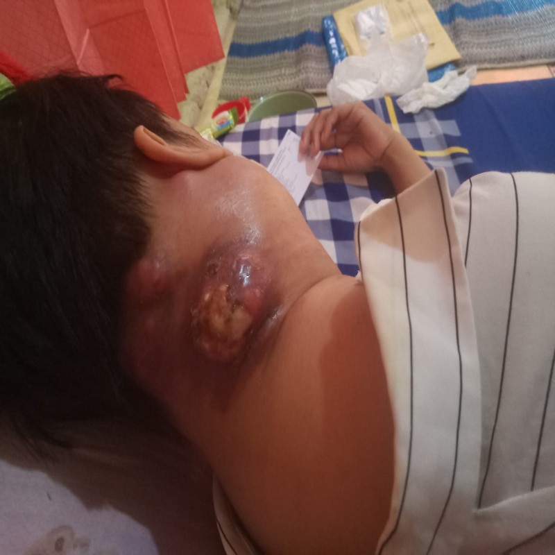 SEORANG IBU ANAK SATU, NURHAYATI IDAP KANKER GETAH BENING SUDAH SANGAT PARAH