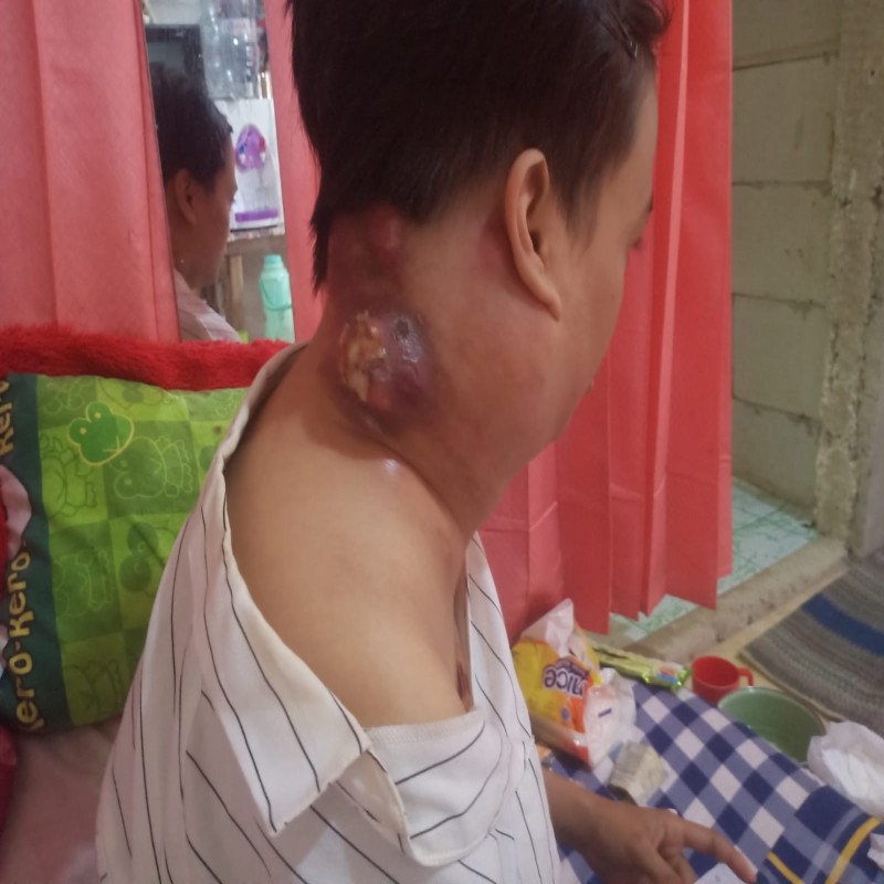 SEORANG IBU ANAK SATU, NURHAYATI IDAP KANKER GETAH BENING SUDAH SANGAT PARAH