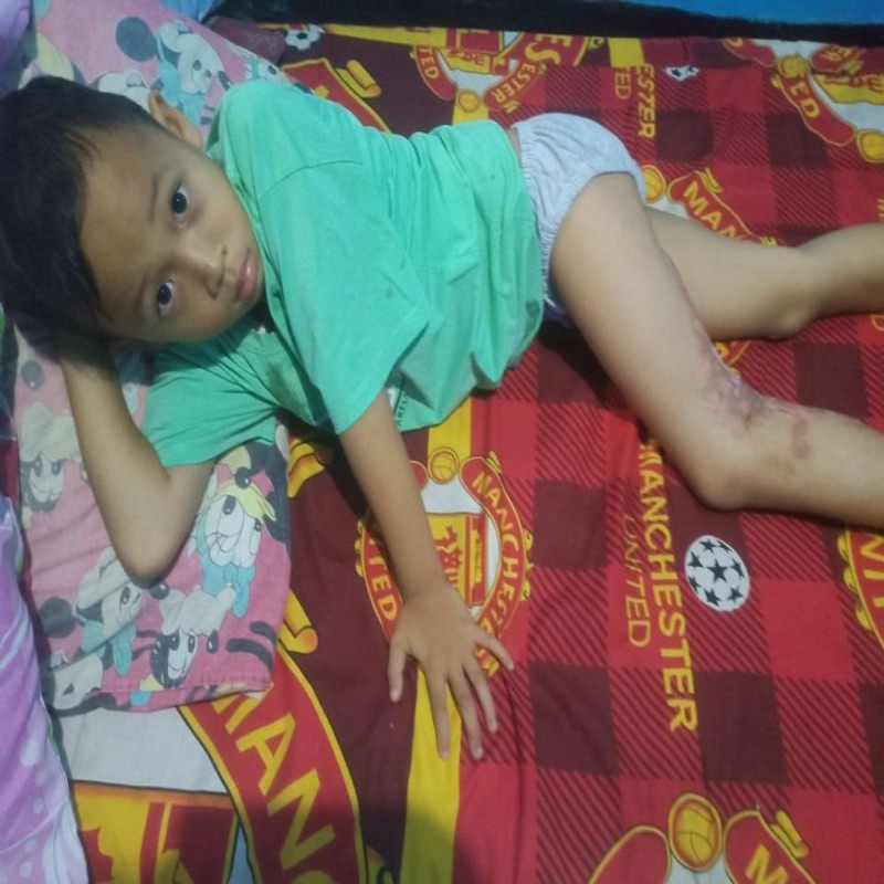 RADIT 7 TAHUN IDAP LUKA BAKAR DAN BERUBAH MENJADI KANKER