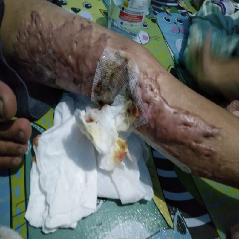 RADIT 7 TAHUN IDAP LUKA BAKAR DAN BERUBAH MENJADI KANKER