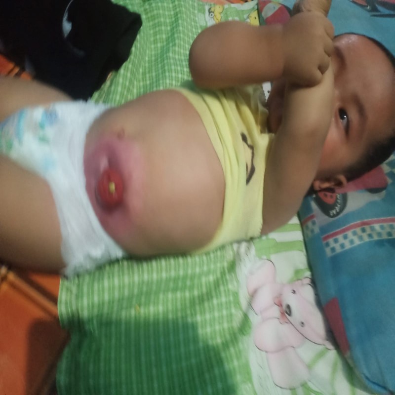 BAYI AKBAR IDAP HIRSCHSPRUNG'S DISEASE