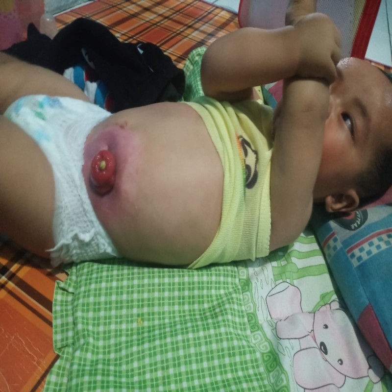 BAYI AKBAR IDAP HIRSCHSPRUNG'S DISEASE