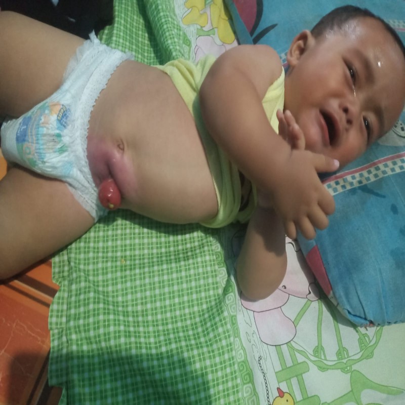 BAYI AKBAR IDAP HIRSCHSPRUNG'S DISEASE