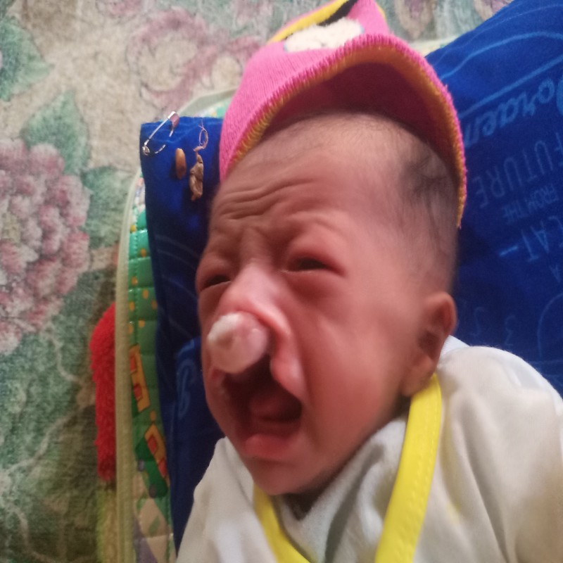 BAYI NADHIFA IDAP KELAINAN PADA BIBIR