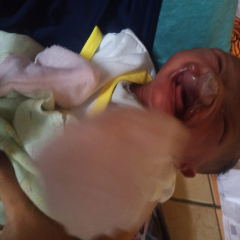 BAYI NADHIFA IDAP KELAINAN PADA BIBIR