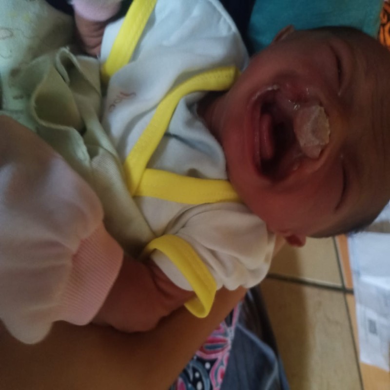 BAYI NADHIFA IDAP KELAINAN PADA BIBIR