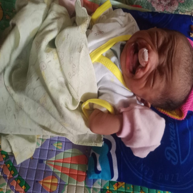 BAYI NADHIFA IDAP KELAINAN PADA BIBIR