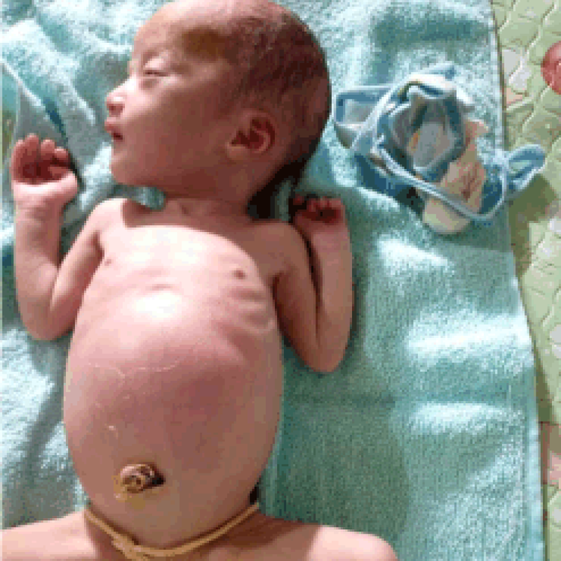 Mengidap Kanker Usus, Bayi Annisa Terancam Gizi Buruk