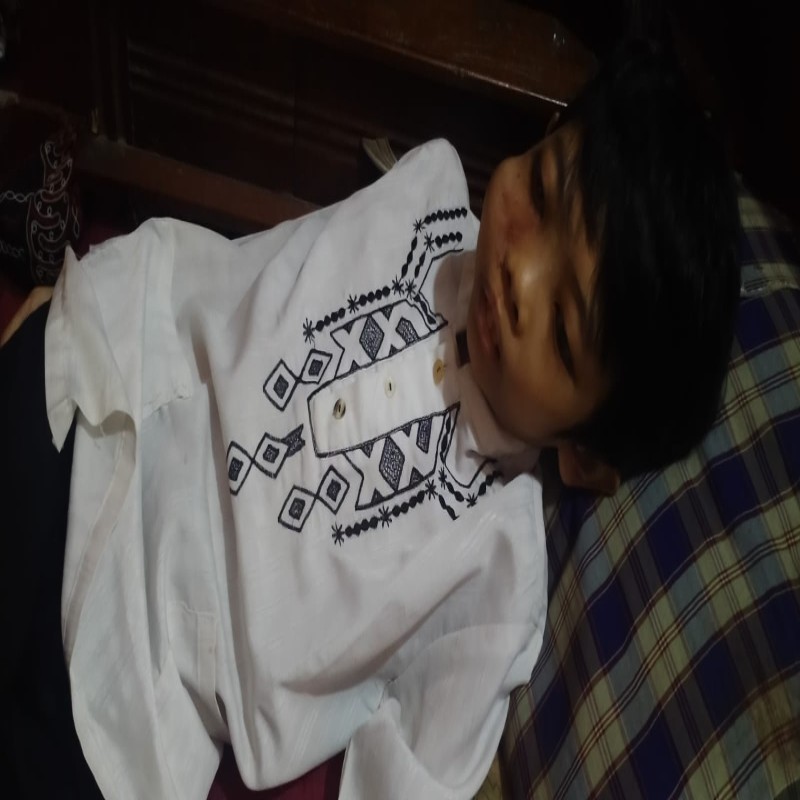 WAJAH MEMBENGKAK, TEGUH HARUS SEGERA OPERASI