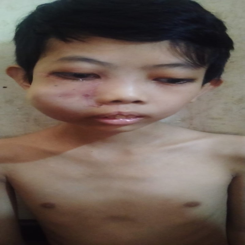 WAJAH MEMBENGKAK, TEGUH HARUS SEGERA OPERASI