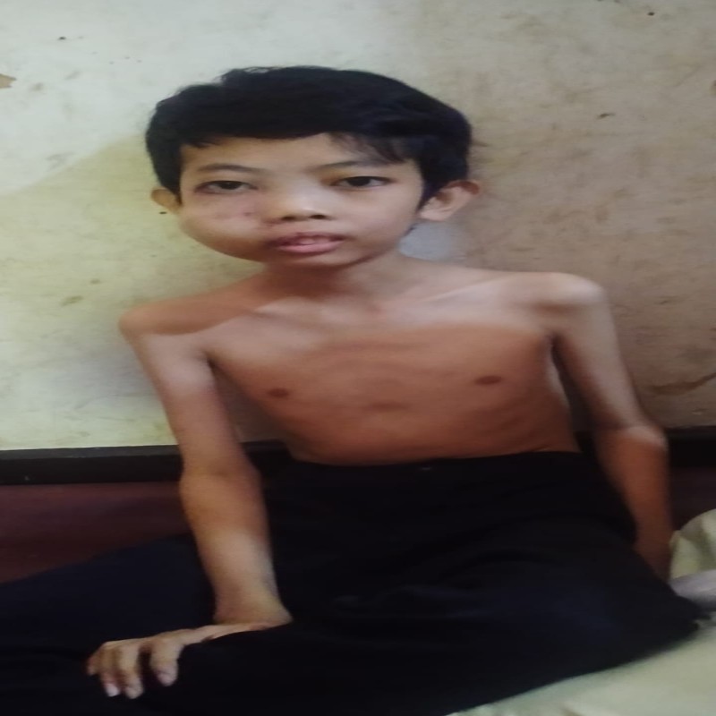 WAJAH MEMBENGKAK, TEGUH HARUS SEGERA OPERASI