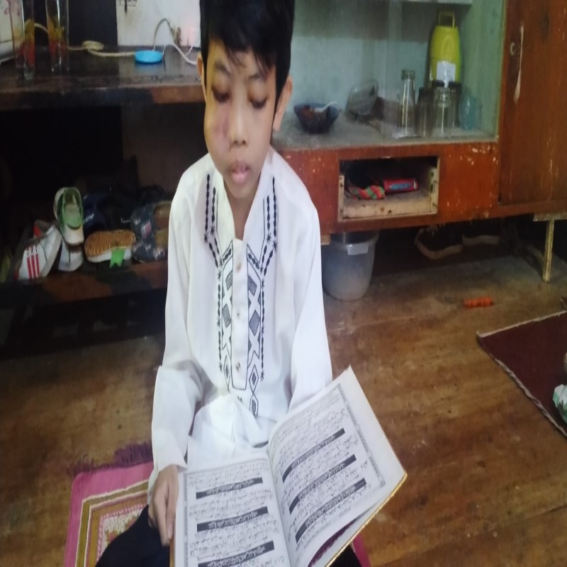 WAJAH MEMBENGKAK, TEGUH HARUS SEGERA OPERASI