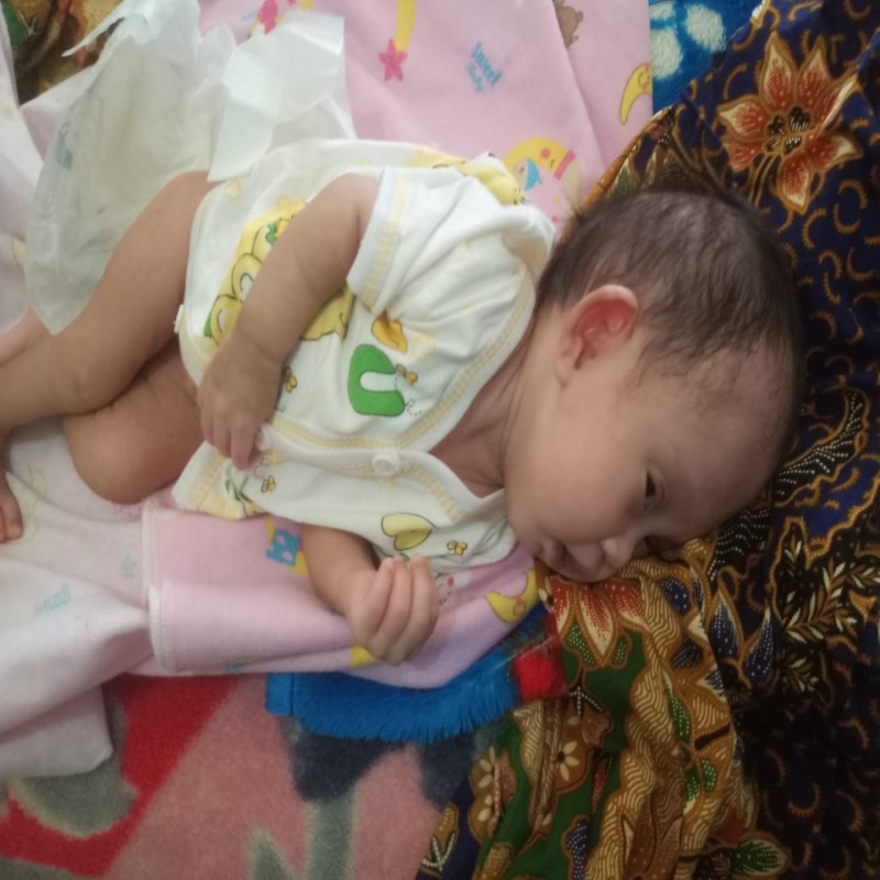 BAYI NURUL ANAK KULI IDAP PENYAKIT LANGKA