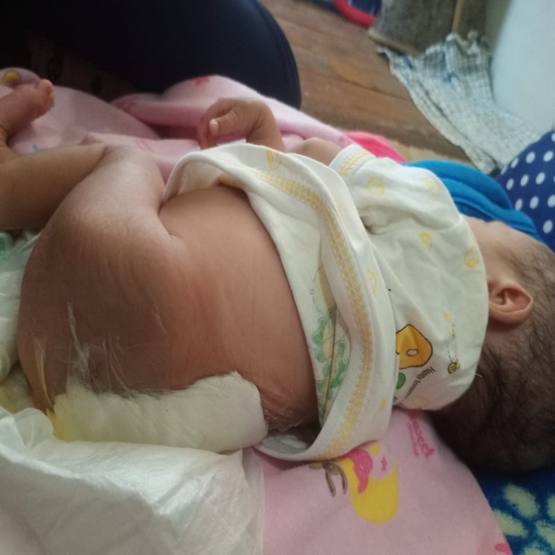 BAYI NURUL ANAK KULI IDAP PENYAKIT LANGKA