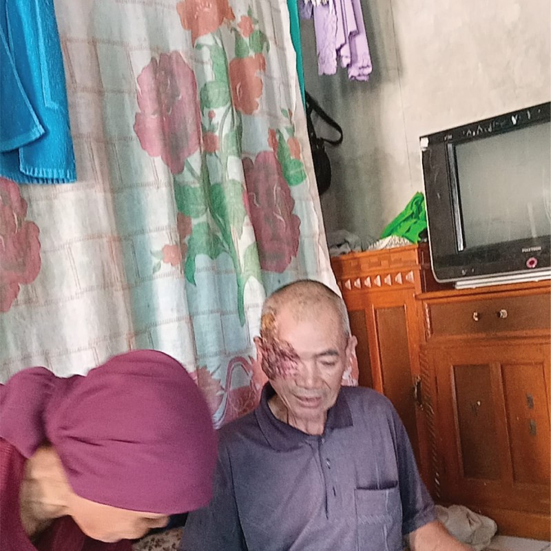 Kanker Ganas Merusak Mata dan Setengah Wajah, Bantu Pak Koko Segera Jalani Operasi