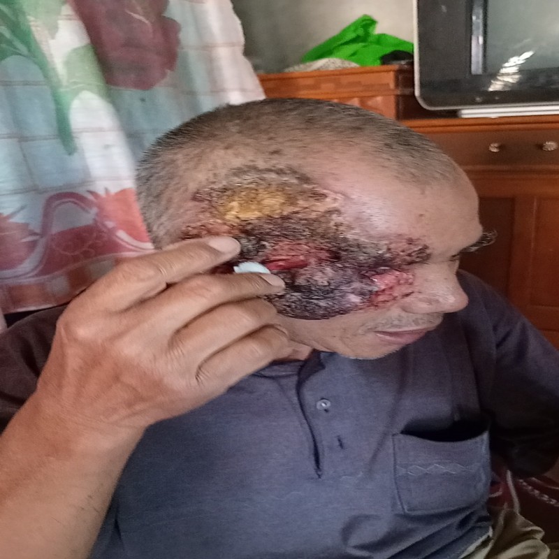 Kanker Ganas Merusak Mata dan Setengah Wajah, Bantu Pak Koko Segera Jalani Operasi