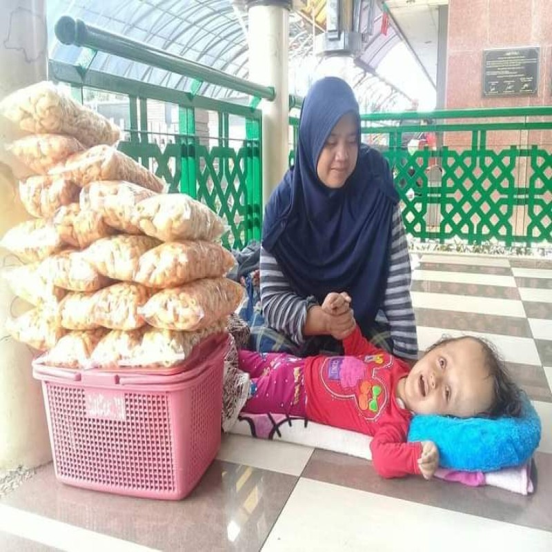 ANAK PENJUAL MAKARONI JALANAN, TAK MAMPU OPERASI CINDY HIDROSEPALUS