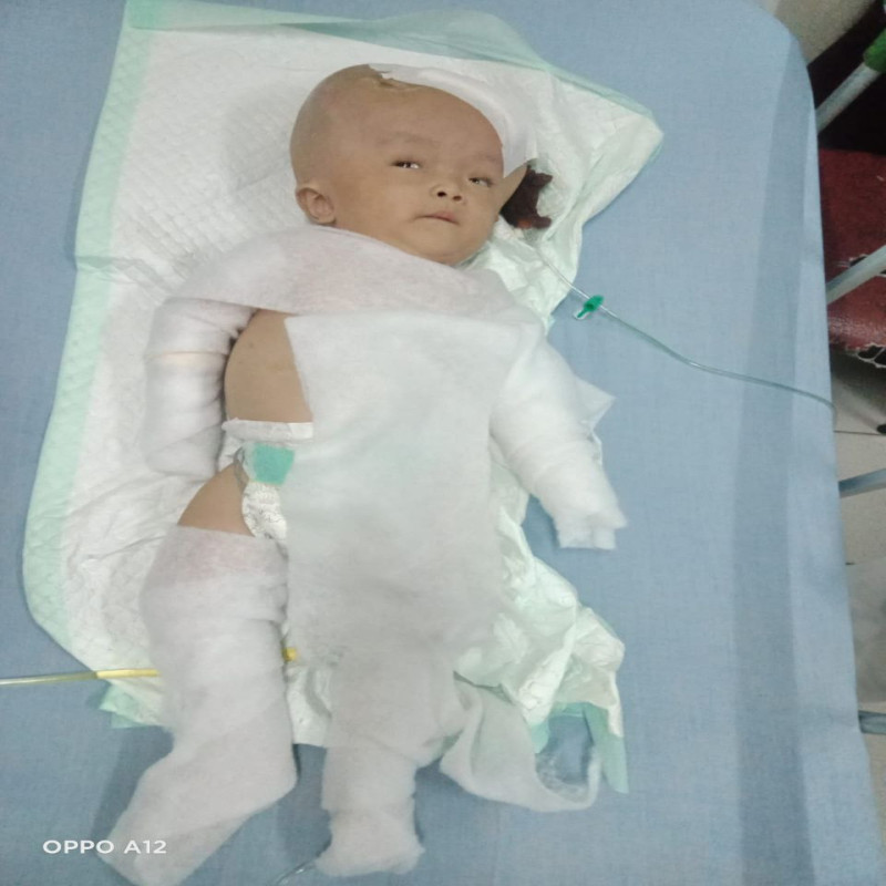 Hidrosefalus Epilepsi dan Spinabifida 3 Penyakit Sekaligus Menyerang Fariz!!