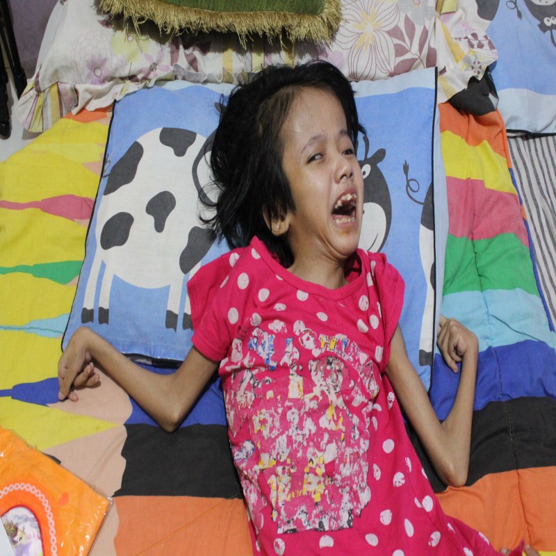 17 Tahun Menderita Hidrosefalus Pengobatan Vira Kini Terhenti