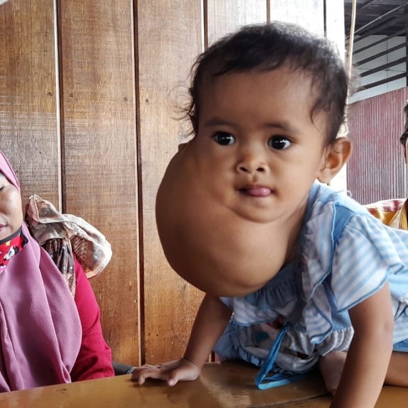 Bantu Adik Febri Operasi Perbaikan Kulit