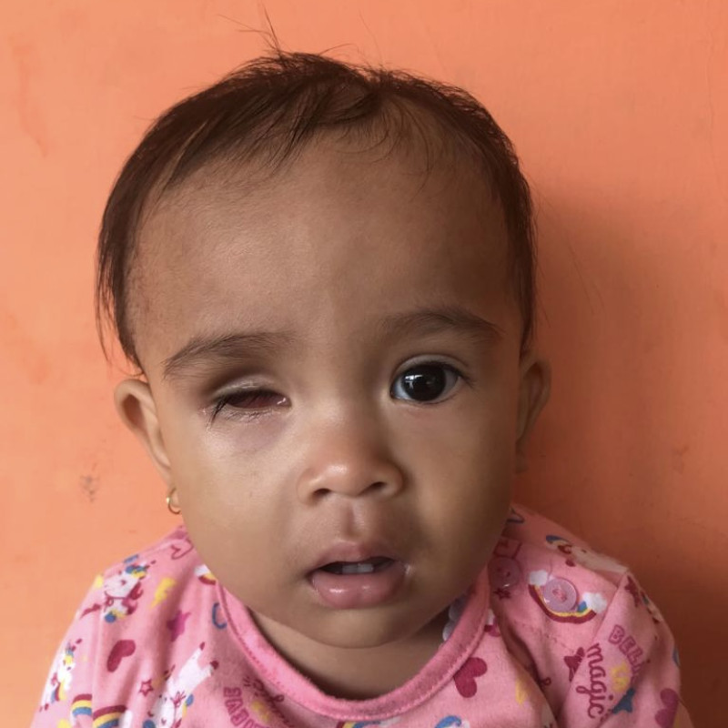 Kanker Merenggut Mata dan Mengancam Nyawa, Tolong Ciara!