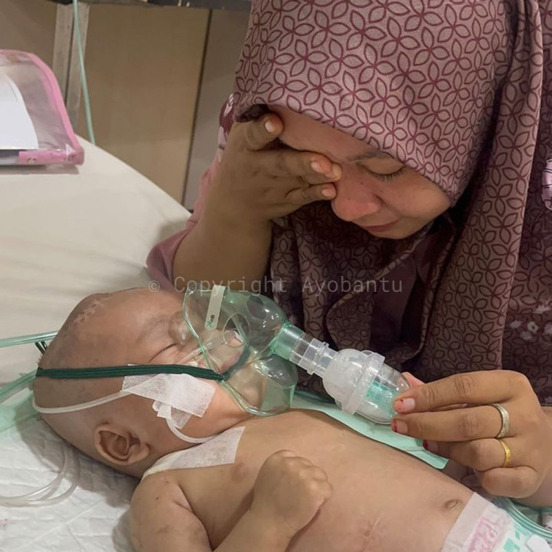 Selamatkan Ratu dari Hidrosefalus