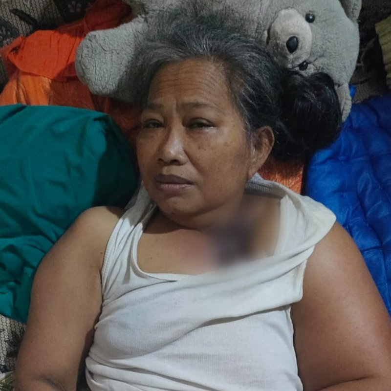 Tumor Mengganas dan Membusuk di Payudara Ibu Sri