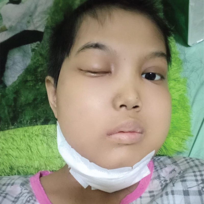 Kuatkan Perjuangan Selly Melawan Kanker Nasofaring yang Mengancam Nyawanya