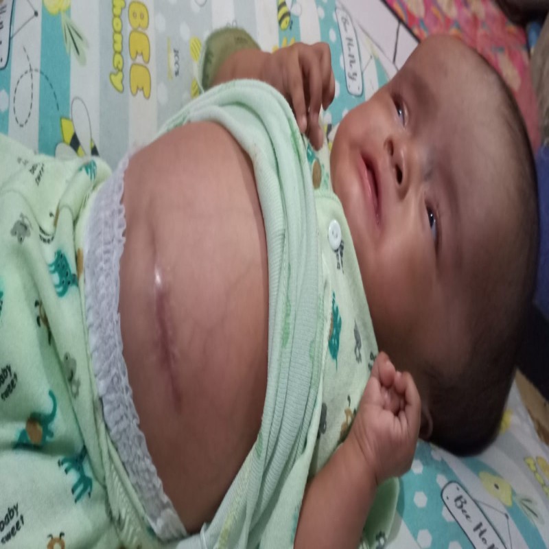 BANTU KAYLA, BAYI BU DESI IDAP HYDROCEPHALUS